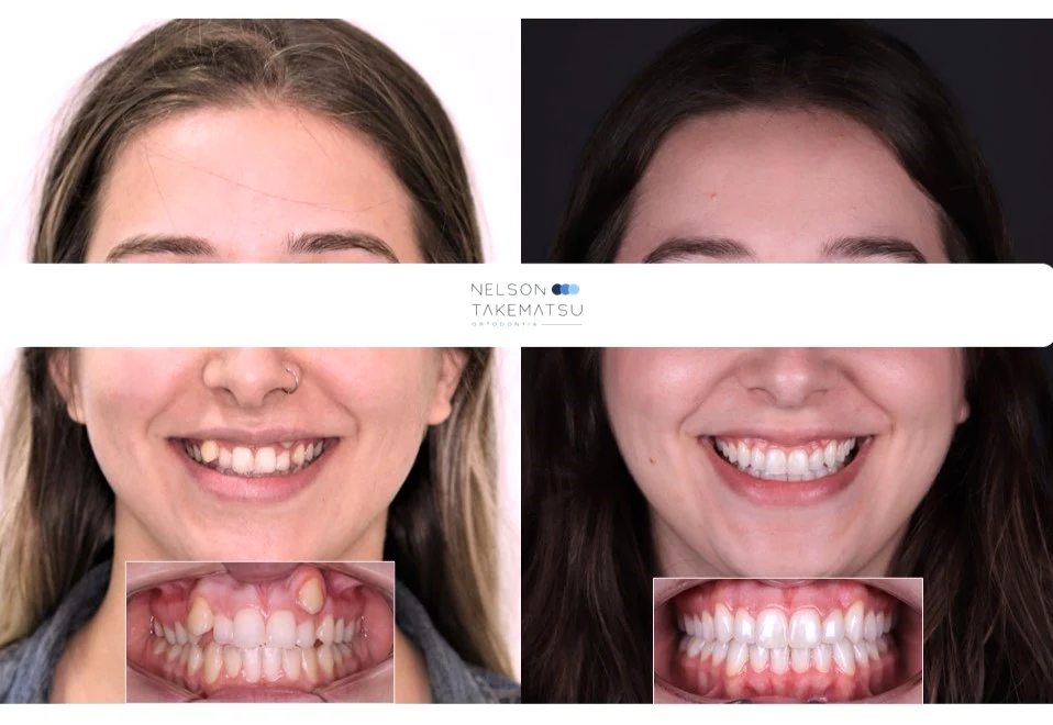 Caso 1 — comparação facial antes e depois