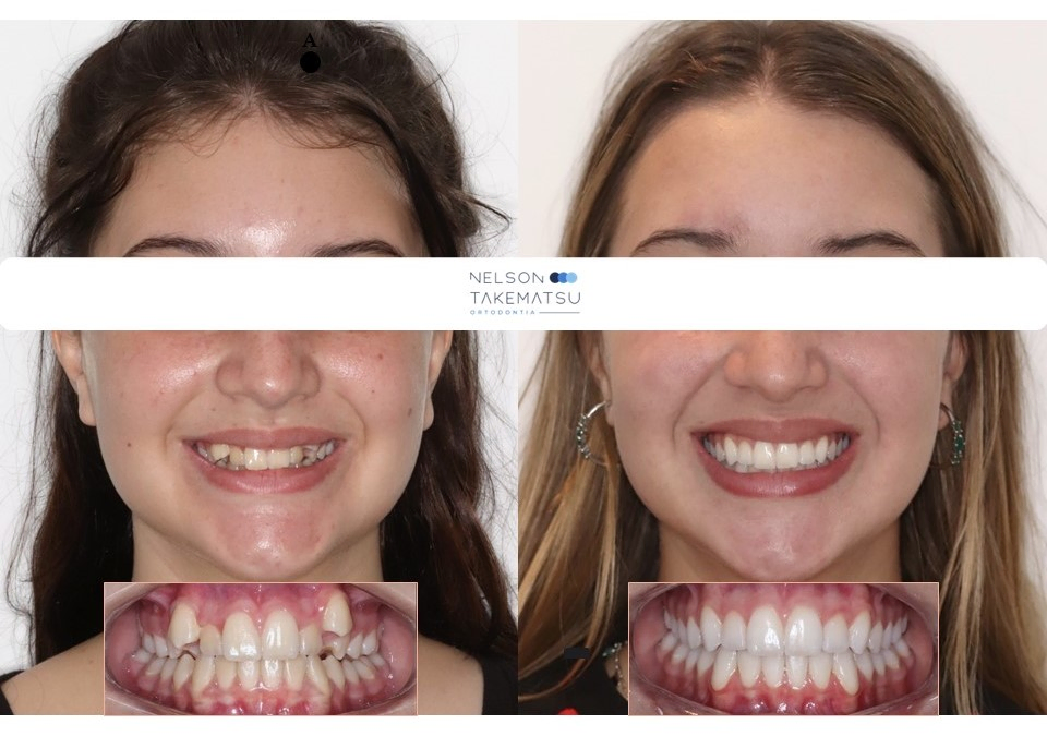 Caso 2 — comparação facial antes e depois
