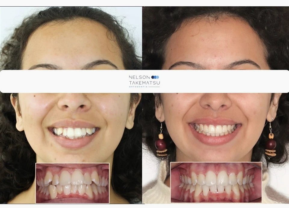 Caso 3 — comparação facial antes e depois