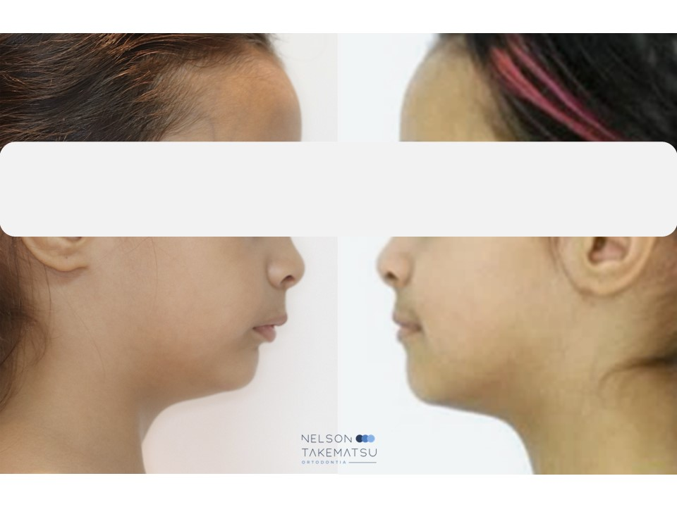 Tratamento de avanço mandibular — mandíbula pequena — antes e depois em perfil