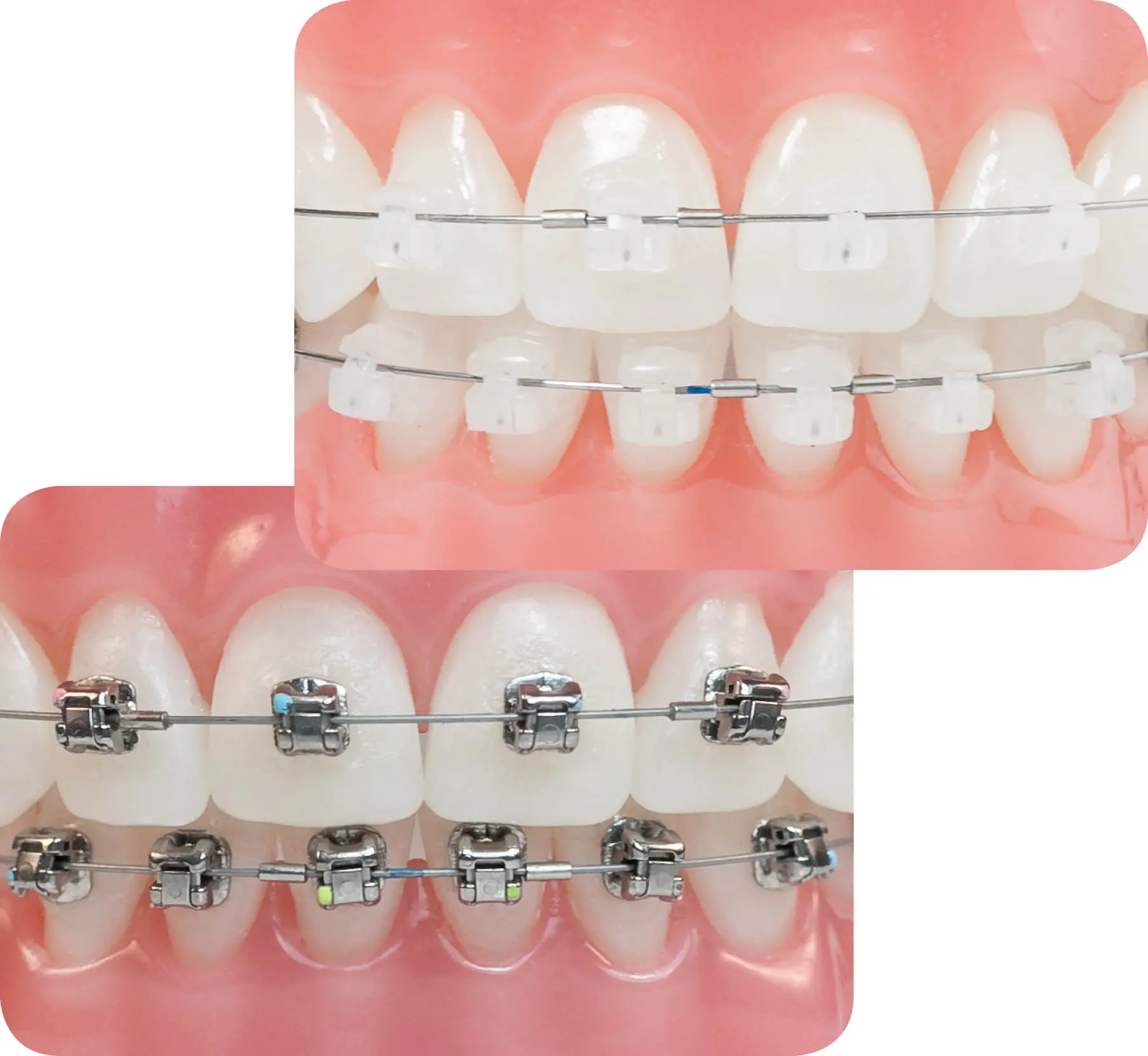 Aparelho ortodôntico autoligado Damon — versão estética cerâmica e metálica